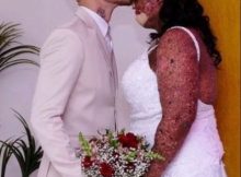 Woman with rare skin condition overcomes negativity and finds true love